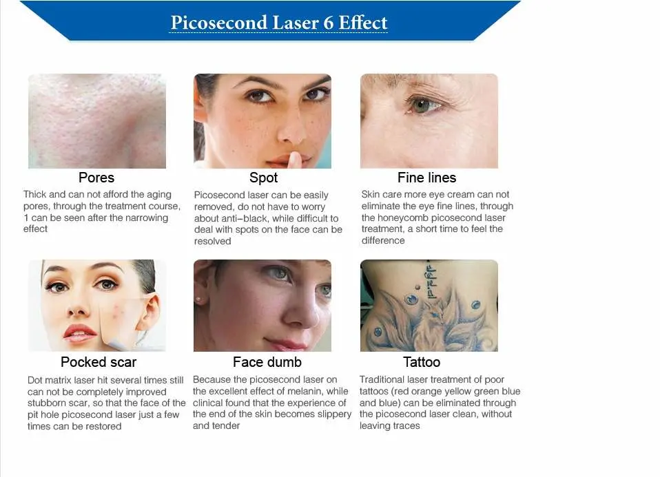 2023 High Effective Picosecond ND YAG Tattoo Removal Laser Device